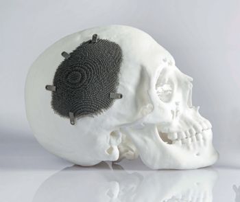 Additively manufactured cranial implant 