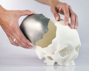 '3-D printed' cranial implants approved