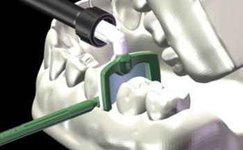Rapid injection moulding helps DMG Dental