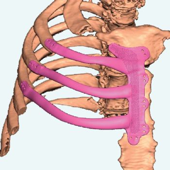 Renishaw 3-D prints rib implant