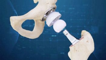 3-D designed total hip replacement surgeries
